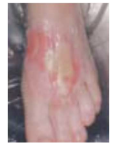 Low-temperature burns
