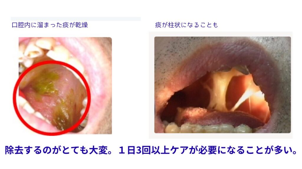 口が開いた状態が続き痰が固まった様子